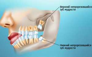 Зуб мудрости 
