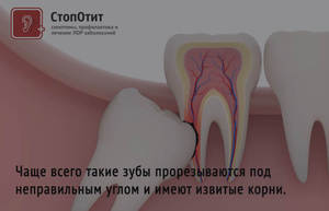 Как ухаживать за полостью рта после удаления зуба