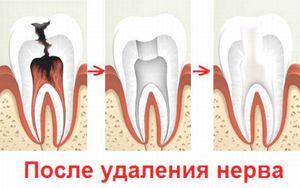 Как удаляется зубгной нерв