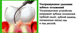 Как удаляют зубные камня