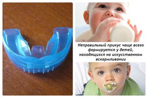 Почему возникает неправильный прикус