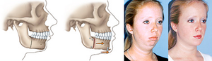 Лечение неправильного прикуса