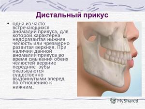 Исправление прикуса