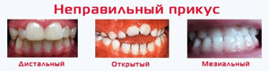 Методика исправления прикуса