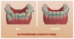 Какие есть медоты исправления прикуса