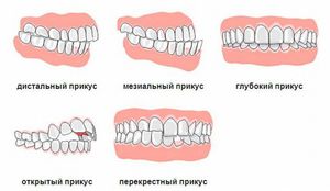 В каком возрасте надо исправлять прикус