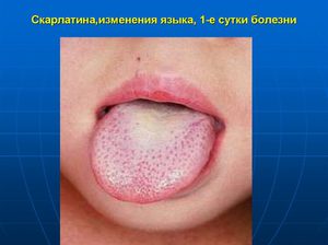 Почему на языке налет