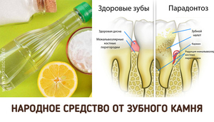 Как удалить зубной камень в домашних условиях