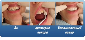 Как правильно вставить виниров
