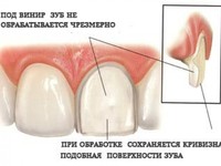 Стоимость виниров