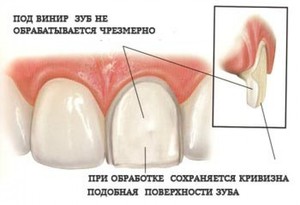 Стоимость виниров