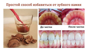 Как чистить зубы от налета