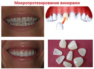Сколько стоит установить виниры