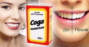 Какими средствами отбеливают зубы