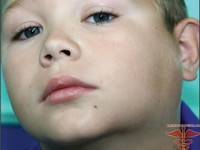 Лимфаденит: лечение заболевания