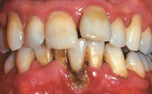 Заболевание периодонтит