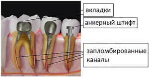 Наращивание зуба с помощью штифта