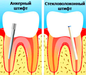 Что такое зубной штифт