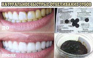 Народные способы отбеливания зубов