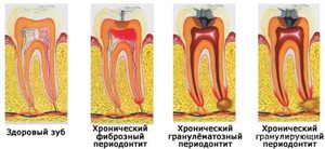 Заболевание периодонтит