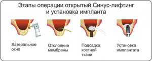 Открытый синус лифтинг-обзор
