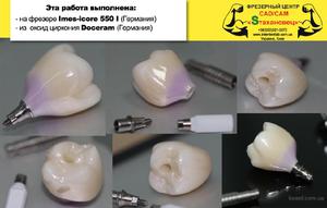 Достоинства материала для изготовления коронки