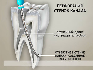 Перфорация стенок корневого канала-обзор