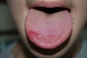 Причины сыпи на языыке