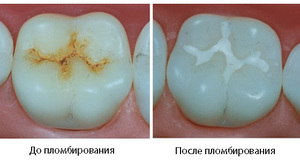 Световая пломба