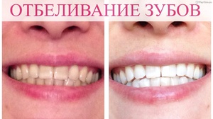Домашнее отбеливание зубов