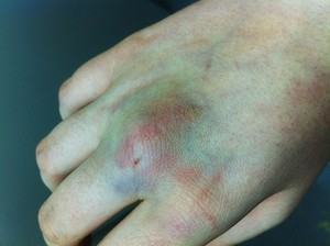 Способы снятия опухоли на руках