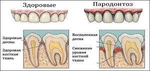Причины оголения десен