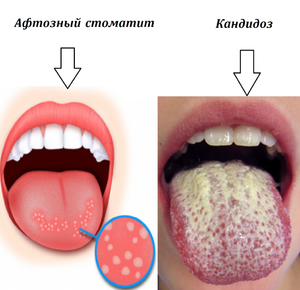 Заболевание Кандидоз