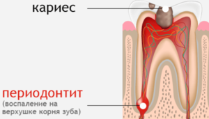 Периодонтит: симптомы