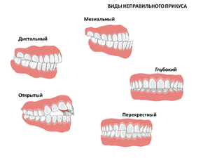 Как исправить неправильный прикус