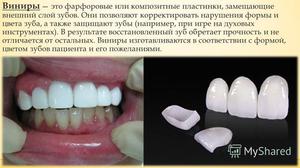 Какие есть виниры
