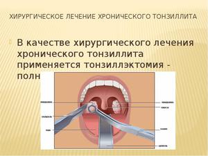 Метод лечения запущенной ангины