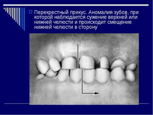 Причины возникновения перекрестног прикуса