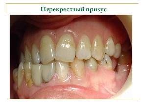 Проявление перекрестного прикуса