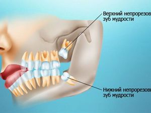 Зачем стоит удалить зуб мудрости