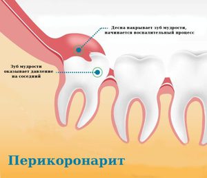 Какие проблемы может вызвать зуб мудрости