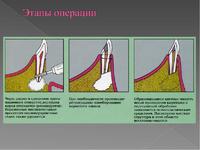 Что такое резекция