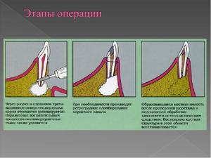 Что такое резекция