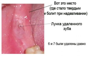 Как долго заживает десна