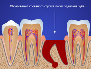 Процедура удаления зуба