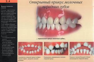 Как исправляют прикус детям