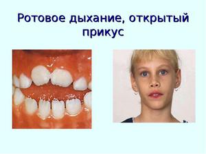 Причины неправильного прикуса