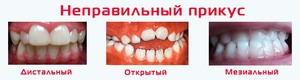 Открытый прикус и его причины